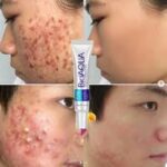 روتین پوستی ضدجوش قوی بیواکوا-شوینده سرم کرم ماسک (ضدجوش) - Image 2